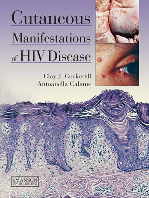 Title details for Cutaneous Manifestations of HIV Disease by Clay J. Cockerell - Available